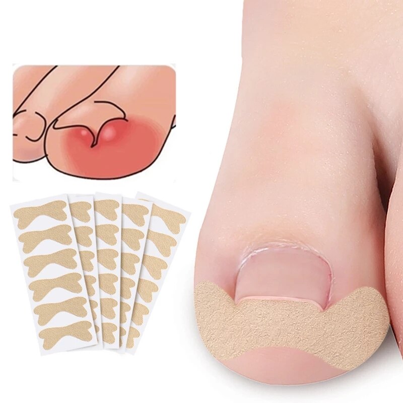 „ÄêRecommend„ÄëNew Ingrown Toenail Corrector Sticker Paronychia Treatment Fixer Recover Corrector bunion Pedicure Foot Toe Nail Care Tool