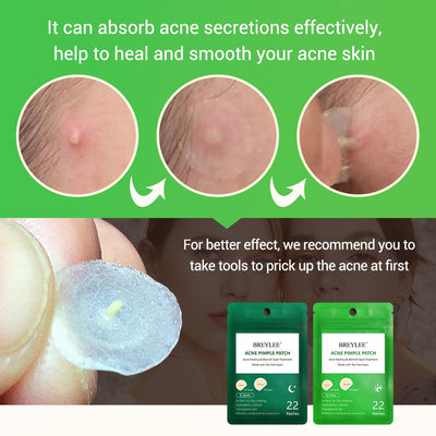 BREYLEE Acne Pimple Patch  Stickers Acne Treatment Pimple Remover Tool Blemish Spot Facial Mask Skin Care  Waterproof 22 Patches